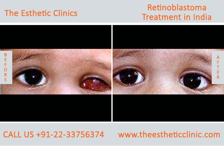 Retinoblastoma Treatment, Retinoblastoma Cancer Surgery before after photos in mumbai india (1